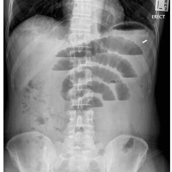 x-ray abdomen erect